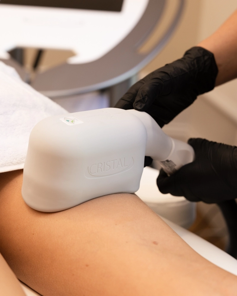 Cryolipolyse banane sous-fessiere