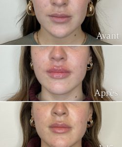 avant après injections aux lèvres